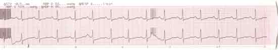 letztes EKG