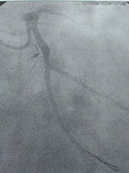 Stent gesetzt