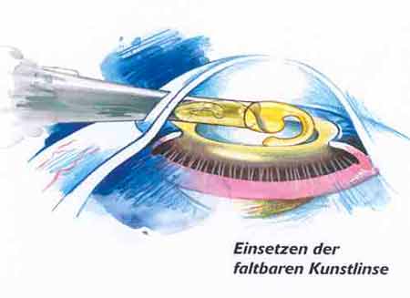 linserein3