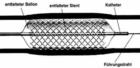 Stent_fertig